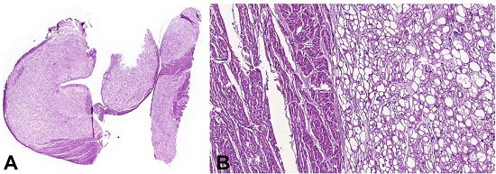 Photomicrograph of the heart. A - Panoramic view of cardiac rhabdomyomas represented by large and clear cell nodules (HE 1x); B - Rhabdomyoma composed of a proliferation of large and vacuolated cells with a centrally placed nucleus and cytoplasmic strands extending to the periphery of the cell &ndash; &ldquo;spider cell&rdquo; (HE 10X).