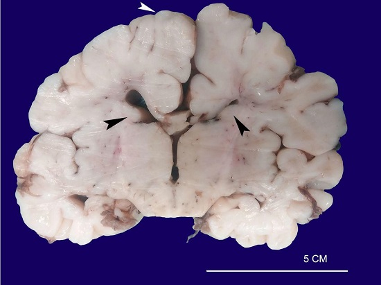 Macroscopic aspect of the brain showing cortical tubers (white arrowhead) and subependymal nodular lesions arising in the walls of the lateral ventricles (black arrowheads).