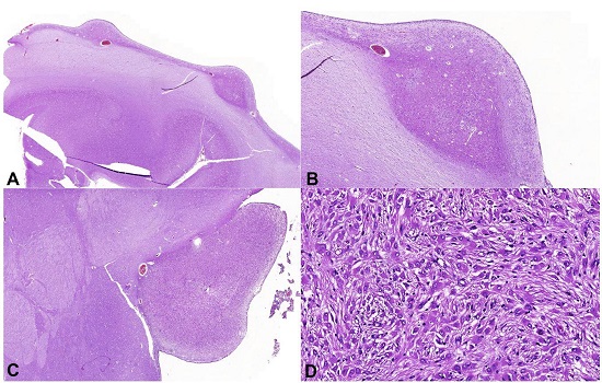 Photomicrographs of the brain. A and B - Subependymal nodules (A, HE 1X; B, HE 3X), comprised by a proliferation of neuronal cells and large and atypical glial cells; C - Large subependymal lesion (HE 1.44X), comprised by the proliferation of large cells of eosinophilic cytoplasm with moderate pleomorphism (D, HE 20X).