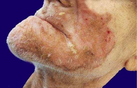 Brownish erythematous scaly lesions with crusts on the perioral region and nasogenic sulcus.