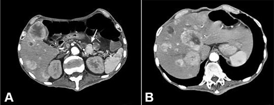 Axial abdominal enhanced CT in the arterial phase showing in A &ndash; an enhanced pancreatic nodule measuring 24 mm at its largest diameter (white arrow), and multiple hepatic nodules with peripheral enhancement and a hypodense center (necrosis); B &ndash; multiple hepatic nodules with peripheral enhancement and a hypodense center (necrosis).