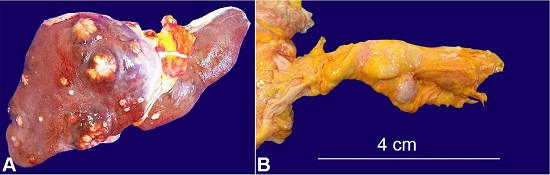 Macroscopic view of the: A &ndash; liver showing multiple hepatic nodules (metastases); B &ndash; nodule in the pancreatic body (neuroendocrine tumor).