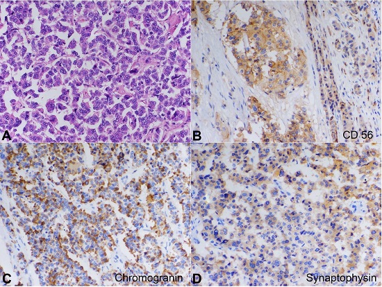 Photomicrographs of the pancreas showing in A &ndash; nodular and diffuse infiltration of round cells with stippled chromatin, inconspicuous nucleoli, and finely granular cytoplasm (H&E, original magnification &times; 100); B &ndash; Immunohistochemical staining positive for CD56 (&times; 100); C &ndash;Immunohistochemical staining positive for Chromogranin A (x 100); D &ndash; Immunohistochemical staining positive for Synaptophysin (&times; 100).