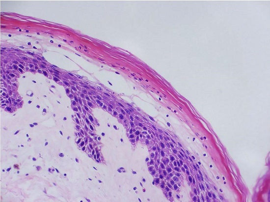 Photomicrograph of the skin showing spongiosis and parakeratotic hyperkeratosis in the upper layer of the epidermis with necrosis, loss of the granular layer, vacuolized and dyskeratotic keratinocytes, compatible with necrolytic nigratory erythema (H&E, original magnification &times; 20).