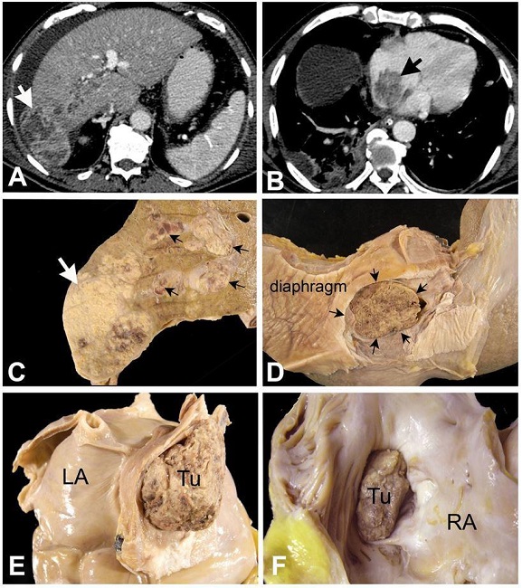 A &ndash; Axial contrast enhanced abdominal CT demonstrates a large heterogeneous mass in the periphery of the right hepatic lobe, with exophytic growth (white arrow), associated with tumoral thrombosis of the right portal vein and ascites; B &ndash; Axial contrast enhanced CT image obtained at the inferior third of the thorax demonstrates the solid mass into the right atrium (black arrow); C, D, E and F are autopsy images: C &ndash; Cross-section of the liver showing the neoplastic mass (white arrow) occupying the right lobe and disseminating via portal and supra-hepatic veins (black arrows); D &ndash; Diaphragmatic surface of the liver showing the inferior vena cava completely occluded by tumoral thrombus (black arrows); E &ndash; Postero-inferior aspect of the heart showing complete occlusion of the inferior vena cava, at its atrial entrance, by a tumor thrombus (Tu); LA- left atrium; F &ndash; Opened right atrium, showing the tumor thrombus invading the right atrial (RA) cavity.