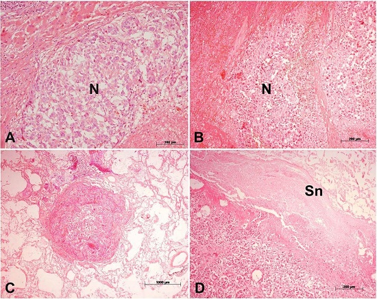 The panel shows some of the microscopic findings. A &ndash; Neoplastic nodule (N) in the liver, showing features of hepatocellular carcinoma; B &ndash; Tumoral thrombus inside the inferior vena cava. The groups of neoplastic cells (N) are intermingled with necrotic debris and fibrin; C &ndash; Small metastatic nodule in the lung parenchyma; D &ndash; Acute pancreatitis. There is extensive steatonecrosis (Sn). (H&E; magnification bars: A &ndash; 100&micro;m; B &ndash; 200 &micro;m; C &ndash;1000 &micro;m; D &ndash; 200 &micro;m).