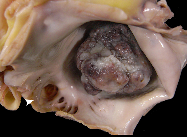 Huge left atrial myxoma (measuring 4.0 &times; 3.5 cm) occupying almost the whole atrial cavity. Note the warty appearance of the tumor surface. The left atrial appendage (arrowhead) is open and does not show thrombosis.
