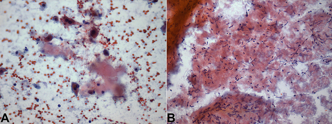 Photomicrography of smears. A, B- Liver and spleen, respectively, showing amorphous and dense orangophilic material (amyloid). The spindle cells in B (stromal and lymphocytes) are compressed by the amyloid. Papanicolaou stain (400X in A and 200X in B).