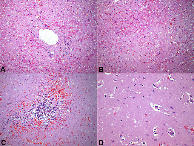 Photomicrography. A- Portal and periportal amyloid deposition in the liver (H&E, 100X); B- Sinusoidal deposition with obliteration of hepatic vein (H&E, 100X); C- Remnant lymphoid follicle in the spleen with diffuse sinusoidal amyloid deposits (H&E, 100X); D- Detail of splenic amyloid substitution (H&E, 400X).