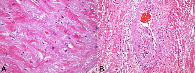 Photomicrography of the myocardium. A- Interstitial amyloid deposits (H&E, 400X); B- Focal organizing thrombosis in a small artery (H&E, 200X).