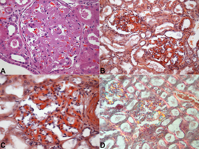 Photomicrography of the kidneys. A- Diffuse glomerular mesangial amyloid deposits (H&E, 400X); B, C- Congo red staining 200X and 400X, respectively; D- Apple-green color of Congo red staining under polarized light (original magnification 200X).