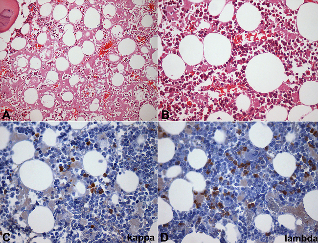 Photomicrography of bone marrow. A- Interstitial deposits of amyloid (H&E, 200X); B- Increased population of plasma cells (H&E, 400X); C, D - Kappa and lambda plasma cells, respectively, showing a clonal expansion of lambda plasma cells (kappa and lambda light chains immunohistochemistry; 40X).