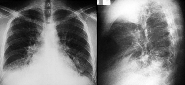 Plain thoracic x-ray showing a normal cardiac silhouette and a heterogeneous opacity in the right inferior pulmonary lobe with a small ipsilateral pleural effusion.