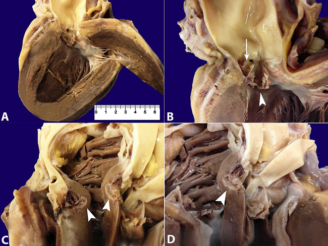 Gross examination of the heart. A - Hypertrophy of the left ventricular wall and collapsed aortic valve cusps; B - Detail of the aortic valve showing one preserved posterior noncoronary cusp and complete destruction of the two coronary cusps. The left coronary cusp is perforated (arrow) and the other showed vegetation (arrowhead); C and D - Valve ring abscess (arrowhead).