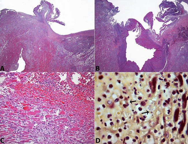 Photomicrography of the valve and ring abscess. A - Panoramic view of the left coronary cusp with a deposition of fibrin and inflammatory exsudate. Note the extensive inflammatory infiltration surrounding the cusps&rsquo; implantation (H&E, 12.5X); B - Panoramic view of the valve ring abscess (H&E, 12.5X); C - Acute inflammation of the surrounding myocardium (H&E, 200X); D - Gram-negative diplococci within the abscess (arrows) (Brown-Hopps, 1000X).