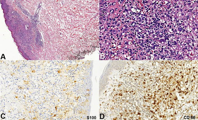 Histology and Immunostains of the skin biopsy. A - Dense infiltrate in the dermis (H&E, 100X); B - Infiltrate composed by histiocytoid cells, lymphocytes, plasma cells and multinucleated cells (H&E, 400X); C - S100 partially positive in epidermal Langerhans cells and dermal infiltrate (anti-S100, 200X); D - CD68 positive in histiocytoid cells of the dermal infiltrate (anti-CD68, 200X).