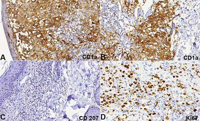 Photomicrography of the Immunostains of the skin biopsy in A and B - CD1a diffusely positive in dermal histiocytoid cells and epidermal Langerhans cells (anti-CD1a, 200X); C - CD207 (Langerin) negative in the demal infiltrate and positive in the epidermal Langerhans cells (anti-CD207, 200X); D - Ki67 positive in about 60% of the dermal cells infiltrate (anti-Ki67, 400X).
