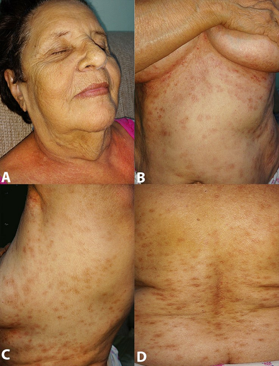 Cutaneous examination after the sixth month of therapy. The face is free of lesions - A; and some erythematous scar-like lesions remain on the trunk - B, C and D