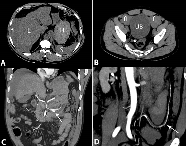 Computed tomography of the abdomen. A and B - Axial plain showing a hematoma (H) in the epiplon retrocavity, and free liquid (fl) in the peritoneal cavity; C and D - Involvement of the medium sized splanchnic arterial bed with an aneurysm in the medium colic artery (arrow in C) and narrowing of the left colic artery by thrombosis and dissection (arrow in D). L = liver; S = spleen; UB = urinary bladder.