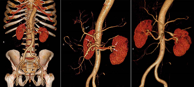 3D reformation of the computed tomography of abdomen showing the involvement of the small and medium sized splanchnic vascular bed with marked narrowing of the celiac trunk branches and superior mesenteric artery. In the central figure, small aneurysms are shown with the white arrows, and the medium colic artery aneurysm is shown with a black arrow. Note that the aorta and iliac arteries are free of lesions.