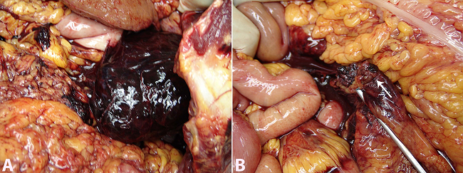 A - Gross aspect of abdominal hematoma upon autopsy; B - Clot and surgical suture of the middle colic artery (arrow).