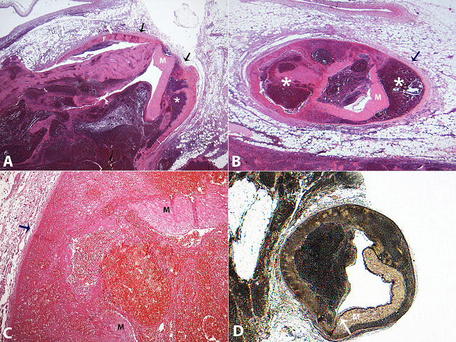 Photomicrography of the medium colic artery. A - Ruptured aneurysm with detachment of the adventitia (arrows) from the outer media (gap-aneurysm [asterisk]) with fibrin (F) and partial necrosis of the media (M) (H&E, 12.5X); B - Dissecting hematoma (asterisk) in the distal segment expansion, and compression of the adventitia (arrow) (H&E, 12.5X); C and D - Gap and rupture of the media (M) with areas of internal elastica (white arrow) loss. (C = H&E, 200X; D = Verhoeff, 12.5X original magnification).