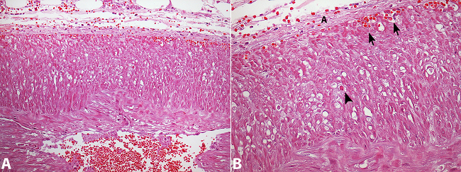 Photomicrography of the medium colic artery. A - Vacuolar change in smooth muscle cells of the media layer (H&E, 200X); B - Vacuolar change, apoptotic cell (arrowhead) and micro hemorrhages (arrows) in the interface between the outer media and adventitia (A) (H&E, 400X).