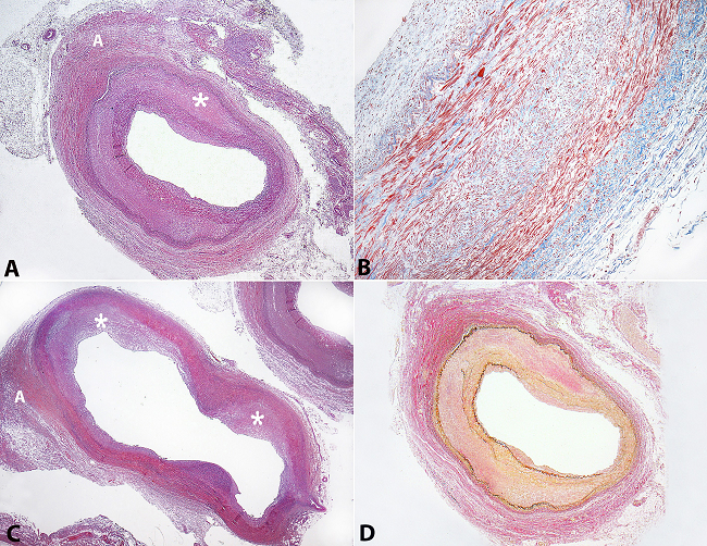 Photomicrography of the left renal artery branch. A - Healed gap (asterisk) between media and adventitia with fibromuscular thickening and adventitial fibrosis (H&E; 12.5X); B - Detail of the fibromuscular gap (Masson’s trichrome; 100X); C - Dilated portion of the left renal artery (aneurysm) showing intimal medial fibrous hyperplasia (asterisk) and adventitial (A) fibrosis (H&E; 12.5X); D - Same artery as in image A. Healed phase of SAM showing a gap between internal (fragmented and duplicated) and external elastica membranes (Verhoeff's Van Gieson stain; 12.5X).
