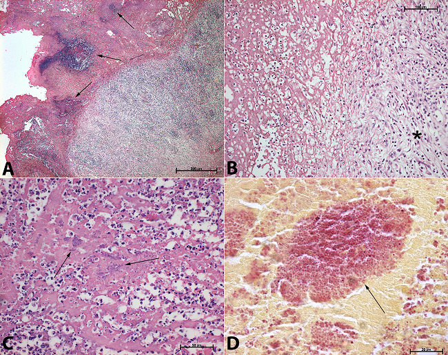 Photomicrography of the vegetation showing clumps of Gram-positive cocci (Staphylococcus aureus): A - Low magnification of the vegetation showing the base of granulation tissue and the top composed of fibrin with polymorphonuclear leukocytes interspersed with bacteria clumps (arrows) (H&E, 25×); B, C - Detail of the top and the region near the base of the vegetation. The arrows points to some clumps of bacteria and the asterisk is at the granulation tissue area at the base, which is consistent with the time history of the endocarditis (H&E, 200× and 400×, respectively); D - The Brown-Hopps stain shows the coccus-shaped bacteria colonies (arrow) with a change in the dye affinity (red), with very few of them purple (Gram-positive) due to the antimicrobial treatment (Brown-Hopps, 1000×).
