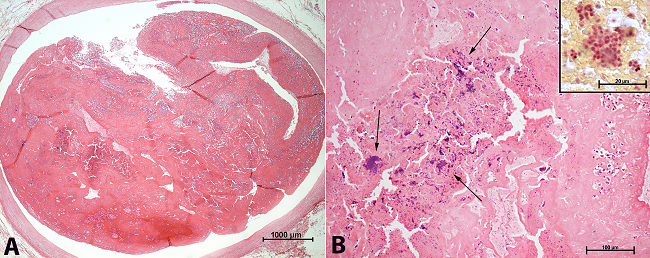 Photomicrography of the transversae section of the left main coronary artery. A - Note the total occlusion of the lumen by the infected embolus, which originated from the vegetation of the mitral valve (H&E, 25×); B - The high magnification shows, in the arterial embolus, the same aspect observed at the mitral valve vegetation, namely, the clumps of coccus-shaped bacteria (arrows) (H&E, 200×) with a change in the dye affinity at the Brown-Hopps staining (inset, 1000×).
