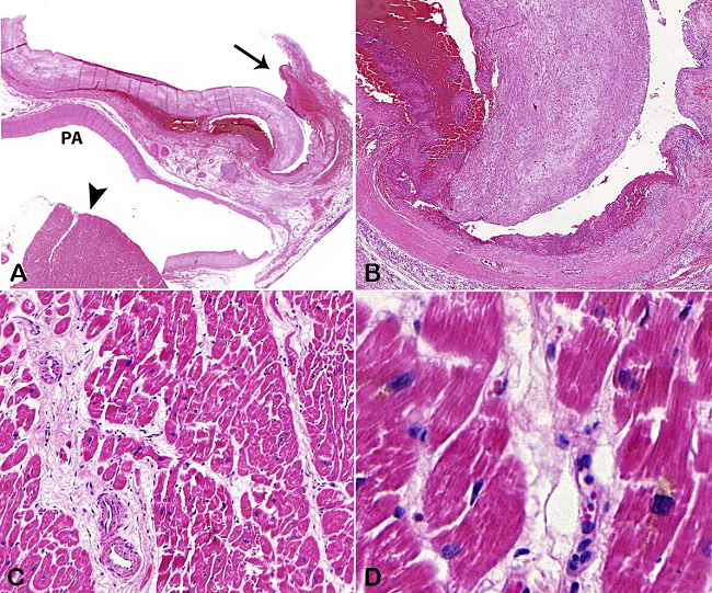 Photomicrographs of the aorta and myocardium. A - A low power view of the point of the rupture of the ascending aortic aneurysm: aorta with bleeding and clot (arrow), pulmonary artery (PA), and septal myocardium (arrow head (H&E, 5X); B - Detail of the fractured atheromatous plaque in the ascending aorta, with bleeding in the media and adventitia (H&E, 200X); C - Perivascular and interstitial myocardial fibrosis (H&E, 100X); D - Cardiomyocyte hypertrophy with cytoplasmic deposition of lipofuscin pigment (H&E, 400X).