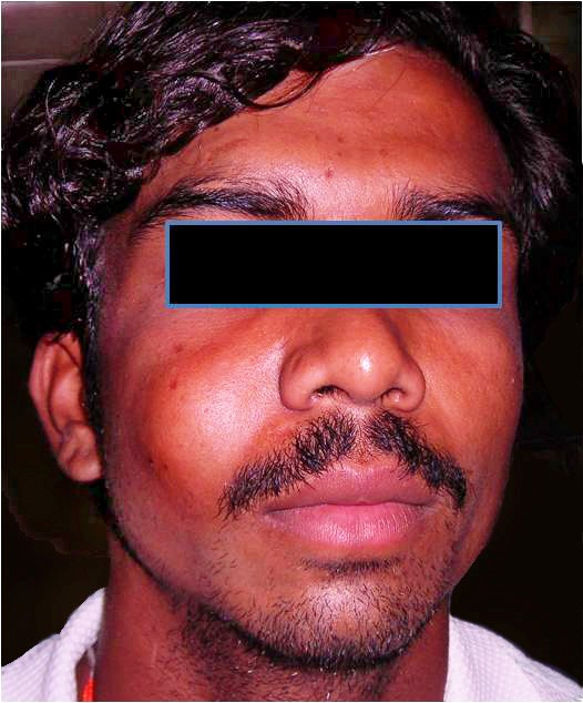 Extraoral (frontal) view showing a swelling over the right maxillary region.