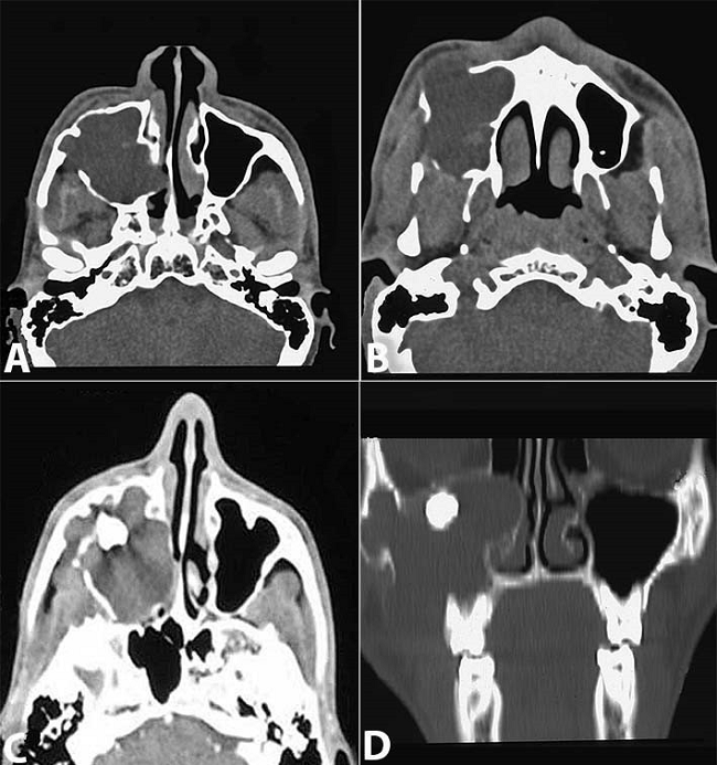 Axial CT of the sinuses. A - Complete opacification of the right antrum; B - Thinning and irregular destruction of the antral walls is evident; C - Displacement of right maxillary third molar; D - Coronal view showing the extensive lesion involving the right antrum and infiltrating into the right nasal cavity.