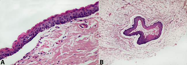 A - Photomicrograph of cyst wall showing parakeratinized lining epithelium with basal palisading and surface corrugations. Note the separation of epithelium from the underlying capsule (H&E, 200X); B - Photomicrograph of the lesion showing keratin-filled daughter cysts within the cystic capsule (H&E, 100X).
