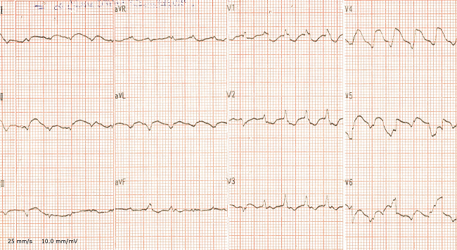 Twelve-lead electrocardiogram (ECG) showing ventricular tachycardia (ECG on admission).