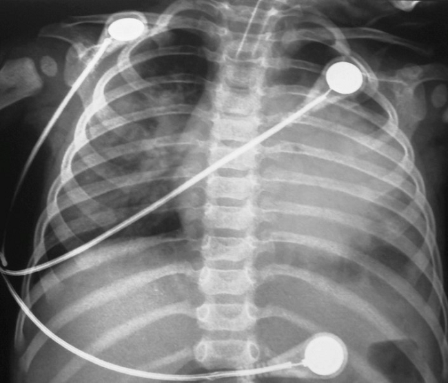 Chest x-ray showing cardiomegaly with bilateral pulmonary congestion.
