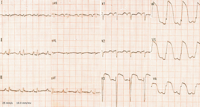 Twelve-lead electrocardiogram (ECG) showing ST segment elevation on the anterolateral leads (V3-V6) and ST depression on V1-V2 (ECG 3 hours after admission).