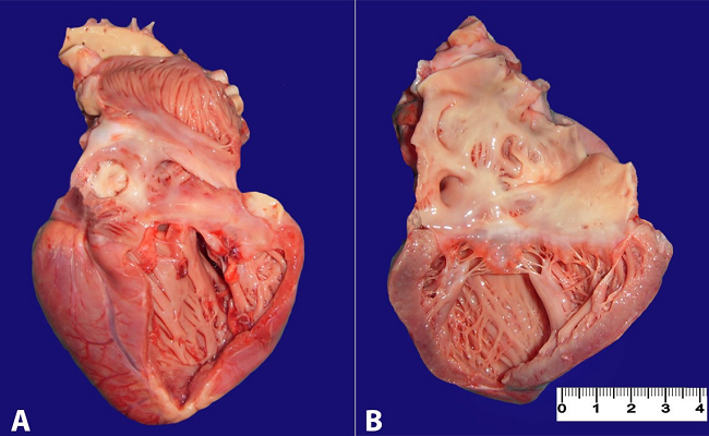 A and B - Gross examination of the heart: right and left ventricles dilatation with homogeneous heart muscle.
