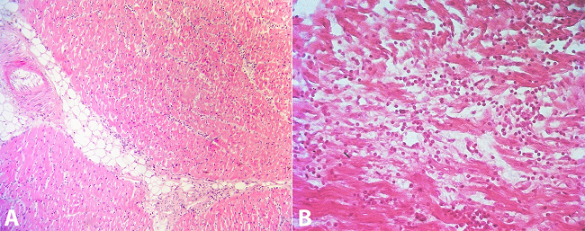 Photomicrography of the heart. A - Myocardiocytes dissociated by interstitial edema and inflammatory infiltrate (H&E, 40X); B - High magnification view shows the inflammatory infiltrate consisting predominantly by lymphocytes (H&E, 400X).