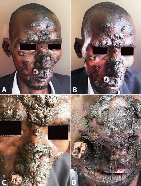 Cutaneous lesions throughout on the face before the antifungal treatment.