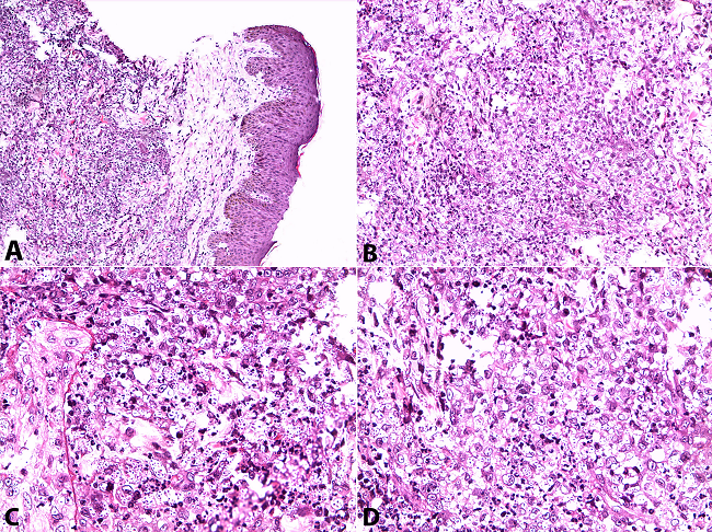 Photomicrography of the skin biopsy. A - Normal epidermis and infiltrated dermis (H&E, 100X); B, C, and D - Small, oval, narrow based yeasts consistent with Histopolasma capsulatum (H&E, 400X).