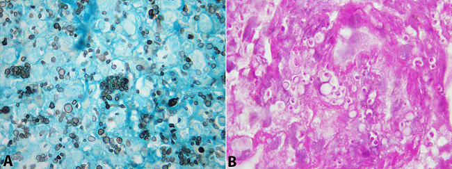 Photomicrography of the skin biopsy showing in A - multiple oval-shaped structures consistent with Histoplasma sp (Grocott, 1000X); in B - PAS staining spores appearing as round or oval structures within the cytoplasm of the macrophages (PAS, 1000X).