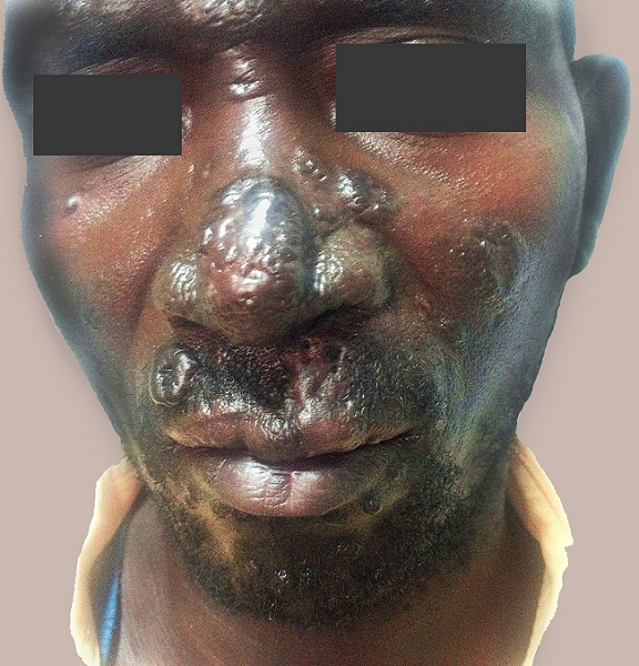 Skin examination after 6 months of treatment.