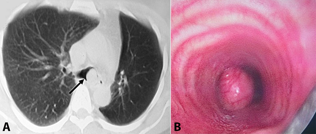 A - Chest CT axial plane showing reduced volume of the left lung and an obstructive lesion (arrow) at the carina obstructing the emergence of the left main bronchus; B - Endoscopic view of the polypoid lesion observed within the left main bronchus.