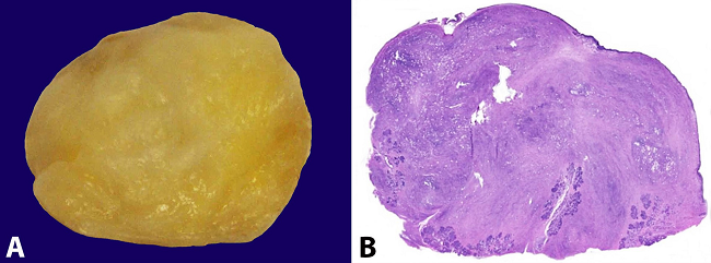 A - Macroscopic view of the light-brownish oval lesion with a bright and irregular surface; B - Photomicrography of the tumor; histologic section showing varied cellularity of the neoplasia. Note the absence of necrosis (H&E, 50X).