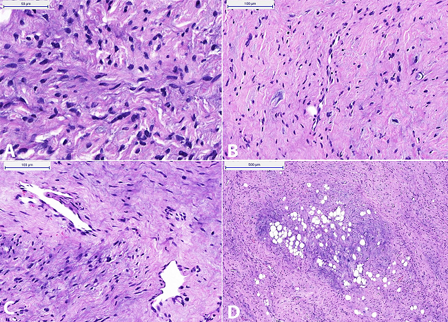 Photomicrography of the tumor. A - Hypercellular neoplastic area; spindle cells with minimal atypia. Note the absence of mitotic activity (H&E, 400X); B - Area of less intense cellularity, with dense collagen and focal myxoid degeneration (H&E, 200X); C - Blood vessels with &ldquo;staghorn&rdquo; configuration (H&E, 200X); D - Spotlights of mature adipose tissue within the fusocellular neoplastic areas (H&E, 200X).