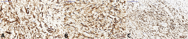 Photomicrography of the tumor. Immunohistochemistry: A - Positivity for CD 34 (400X); B - Positivity for CD 99 (400X); C - Positivity for BCL 2 (200X).