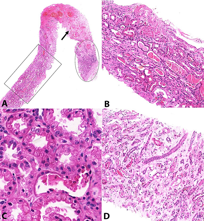 Photomicrography of the kidney biopsy 45 days after transplantation. A - Three areas of the sample are pointed out: (i) unspecific inflammatory process in the subcapsular area, indicated by a circle; (ii) coagulative necrosis, indicated by an arrow; and (iii) tubular degeneration and necrosis indicated by a square (H&E, 20x); B - Cortical with extensive tubular degeneration and necrosis. Note: there were no signs of rejection or infection (H&E, 100X); C - Extensive tubular hydropic degeneration with more detail (H&E, 400X); D - Medulla with intense edema and tubular necrosis; there was an absence of infectious inflammatory infiltrate and papillary necrosis (H&E, 100X).