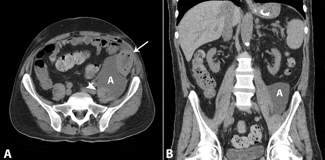 Abdominal CT images. A - Axial image: the graft surrounded by inflammatory process and gas (arrow) in contact with an abscess (A); perigraft abscess in close contact with the psoas muscle (arrowhead); B - Coronal plane. Note the abscess juxtaposed to the psoas muscle.