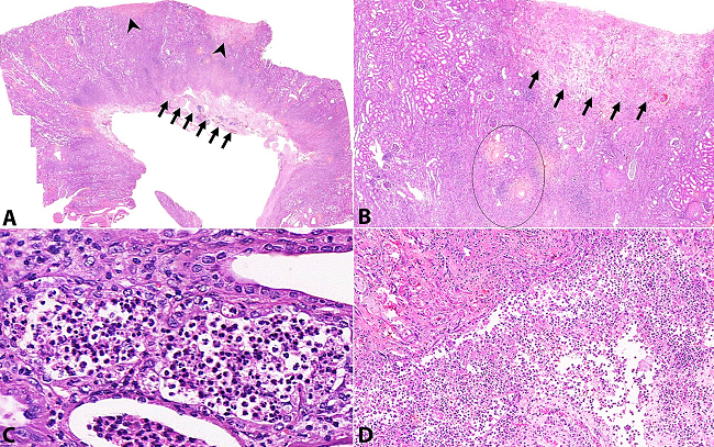 Photomicrography of the kidney. A - Chronic pyelonephritis with necrotizing papillitis (arrow) and, above this area, subcapsular coagulative necrosis (arrowhead) (H&E, 40X). B - Renal cortex with arterial fibroelastosis, indicated by a circle, at the bottom of a shallow area of coagulative necrosis (arrows) (H&E, 200X). C - Chronic pyelonephritis with abscesses (H&E, 400X). D - Necrotizing papillitis (H&E, 400X).